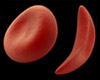 Abnormal blood cell shapes